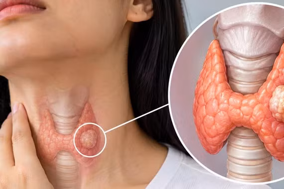 Người trẻ cũng mắc ung thư tuyến giáp: 4 yếu tố nguy cơ cần biết