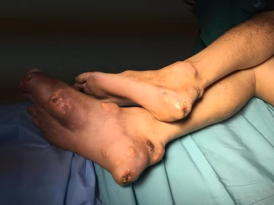 Vô số cục vôi "ăn" vào khớp khuỷa bệnh nhân Vô số cục vôi