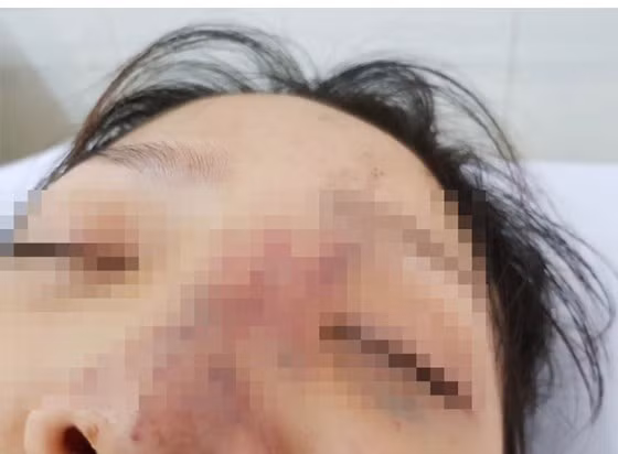  Mắt trái của L. có nguy cơ bị mù và vùng mũi tím tái vì bị tắc mạch gây thiếu máu