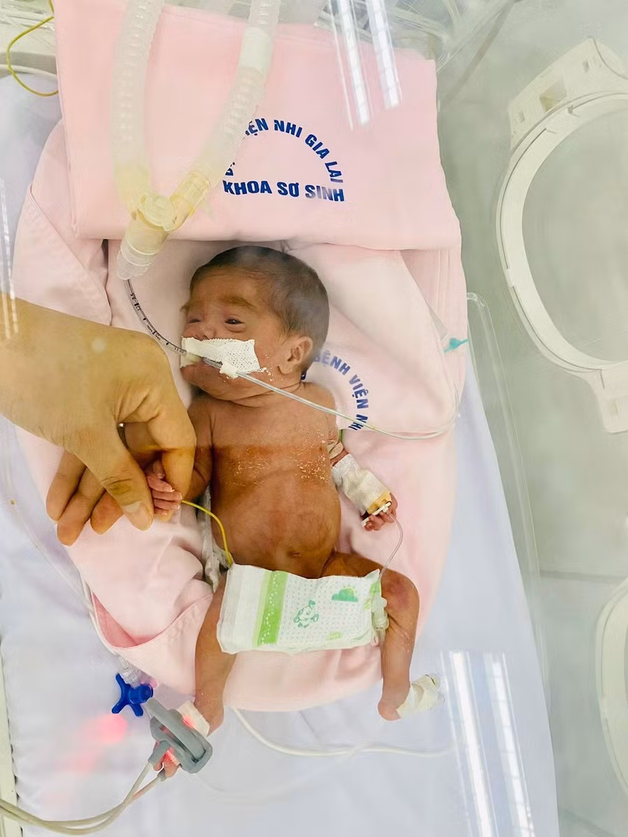 Sau hơn 40 ngày chăm sóc, bé gái sinh non nặng 580g đã tăng lên 910g. Ảnh: Bệnh viện cung cấp