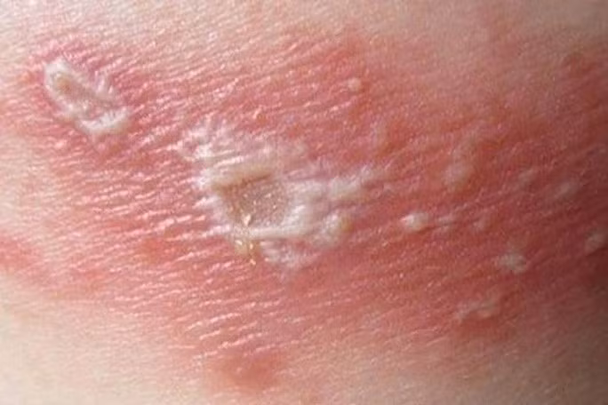 Da có thể bị tổn thương nghiêm trọng nếu bị dính nọc của kiến ba khoang Da có thể bị tổn thương nghiêm trọng nếu bị dính nọc của kiến ba khoang