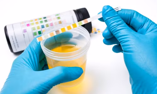 Nước tiểu chứa nhiều loại gene có thể giúp chẩn đoán ung thư tuyến tiền liệt. Nước tiểu chứa nhiều loại gene có thể giúp chẩn đoán ung thư tuyến tiền liệt.