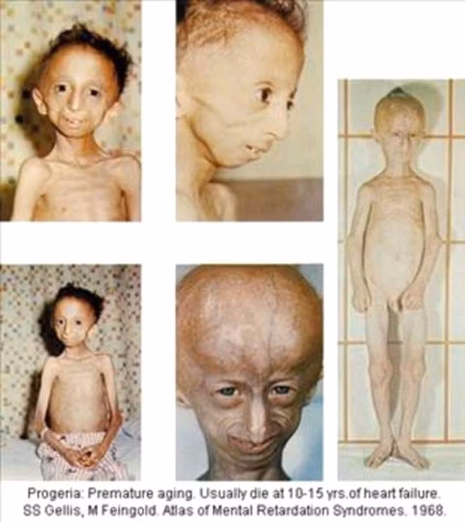Cơ thể của một bệnh nhân mắc Progeria. Ảnh: NBS Sciences.