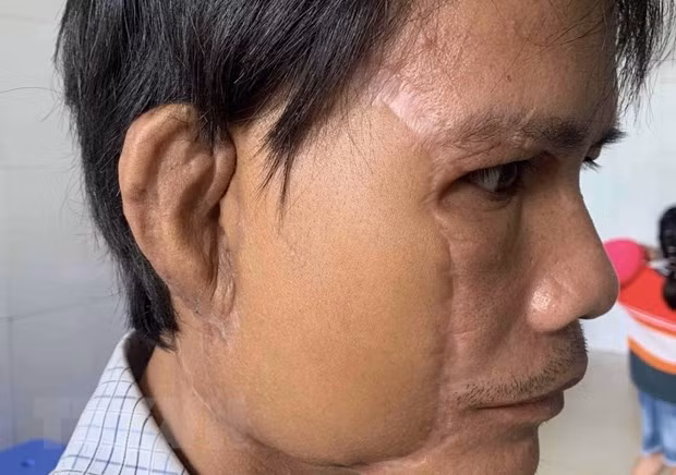 Bệnh nhân khi đã được ghép tai. Ảnh: TTXVN phát