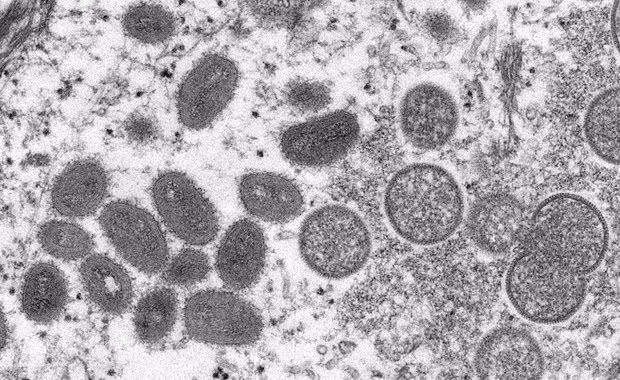  Hình ảnh dưới kính hiển vi cho thấy virus đậu mùa khỉ trong mẫu bệnh phẩm của một bệnh nhân. (Ảnh: Reuters/TTXVN)