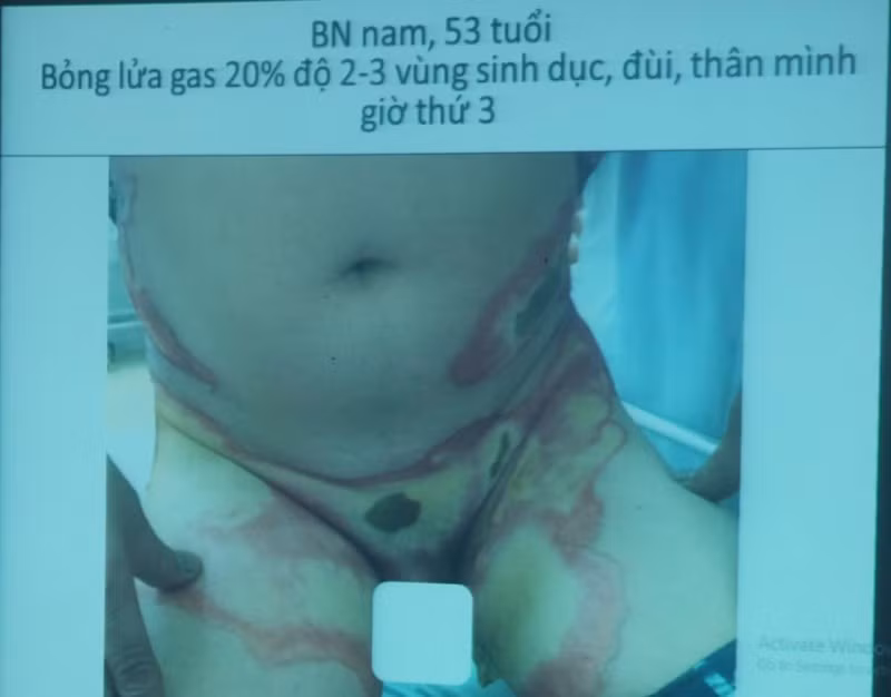 Bật lửa phát nổ gây bỏng nặng vùng dưới của nạn nhân.