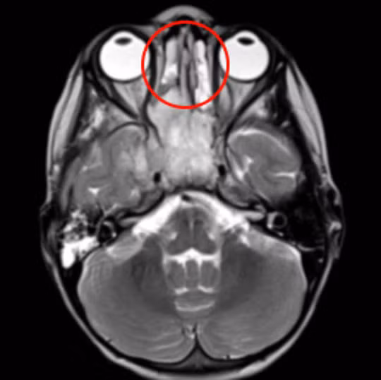 Khối u (khoanh tròn đỏ) được thể hiện trong phim MRI - ảnh do bệnh viện cung cấp