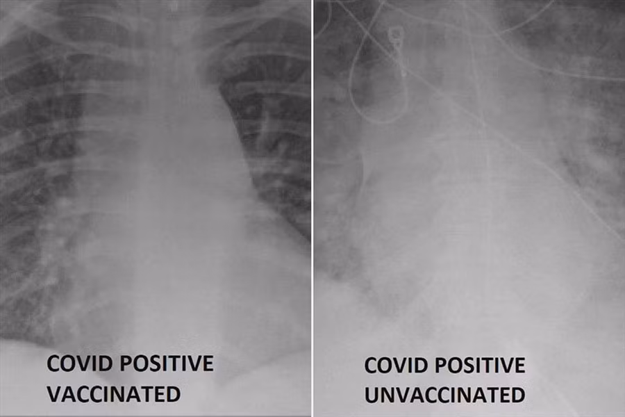 Ảnh so sánh hai phim X- Quang của bệnh nhân mắc COVID-19 được tiêm vaccine (bên trái) và không được tiêm vaccine (bên phải). Ảnh: KDSK
