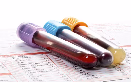 Thử máu và phân tích DNA trong máu có thể dự đoán khả năng bệnh ung thư ở một người - ảnh minh họa từ internet Thử máu và phân tích DNA trong máu có thể dự đoán khả năng bệnh ung thư ở một người - ảnh minh họa từ internet