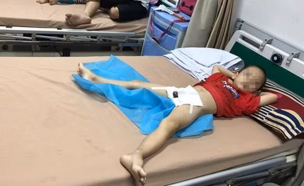  Bé trai tại huyện Khoái Châu mắc sùi mào gà điều trị tại BV Da liễu TƯ 