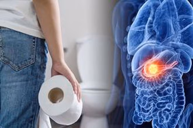Thay đổi trong thói quen đại tiện là một trong những triệu chứng đầu tiên của ung thư ruột ẢNH MINH HỌA: SHUTTERSTOCK