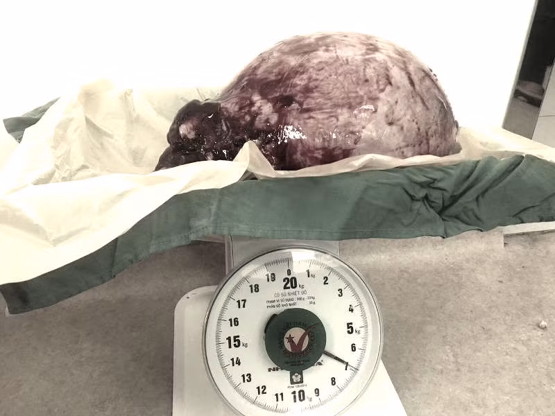 Khối u 7 kg được các BS lấy ra Khối u 7 kg được các BS lấy ra