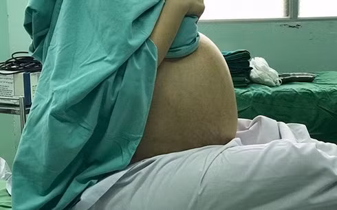  Bệnh nhân mang khối u buồng trứng khổng lồ nhưng tưởng bị béo bụng. (Ảnh: VTC News)