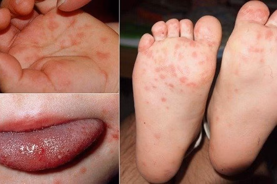Phòng chống dịch bệnh tay chân miệng mùa khai trường.