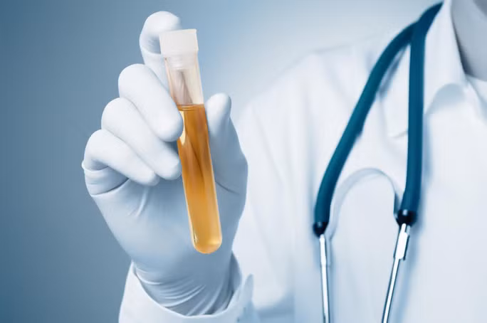 Công cụ xét nghiệm mới sẽ khiến nước tiểu đổi màu xanh lam xám nếu có - ảnh minh họa từ internet