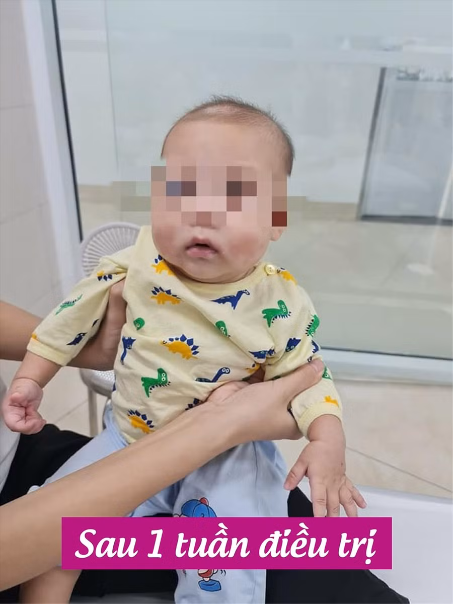 Bé trai sau 1 tuần điều trị. Ảnh: BVCC Bé trai sau 1 tuần điều trị. Ảnh: BVCC