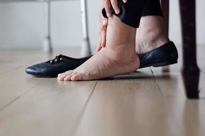 Người bệnh có thể bị sưng phù mặt, chân, mắt cá và bàn chân nếu bị viêm gan mạn tính ẢNH: SHUTTERSTOCK