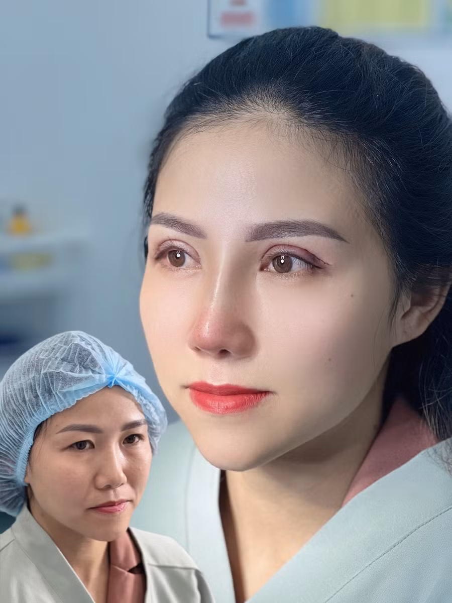 Ảnh trước và sau của một khách hàng nâng mũi, cắt mí tại Thẩm mỹ viện Quốc tế SENSE. Ảnh cơ sở cung cấp Ảnh trước và sau của một khách hàng nâng mũi, cắt mí tại Thẩm mỹ viện Quốc tế SENSE. Ảnh cơ sở cung cấp