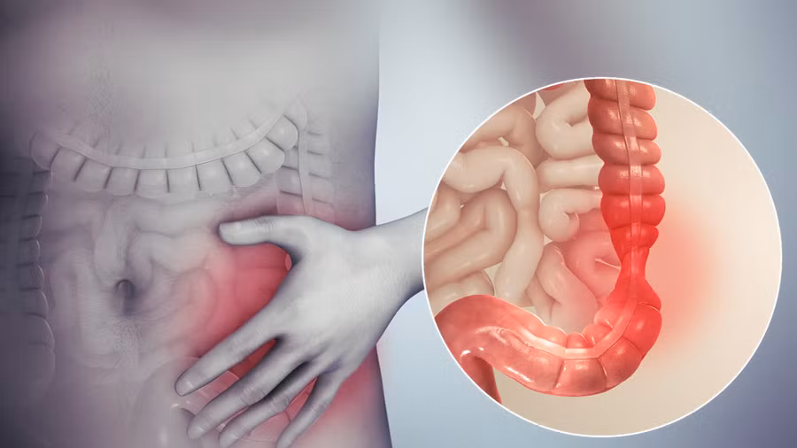 Mật heo có tác dụng rất tốt với bệnh viêm đại tràng. Ảnh: Từ Ân
