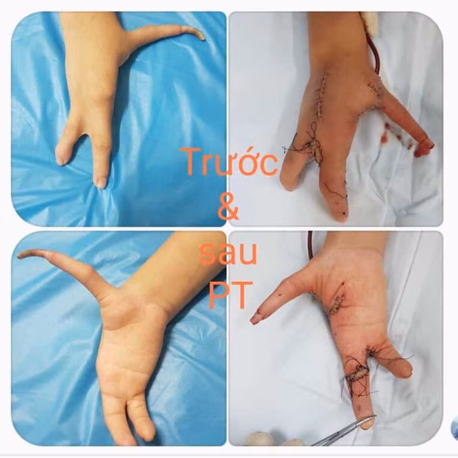 Bàn tay bệnh nhân trước và sau mổ