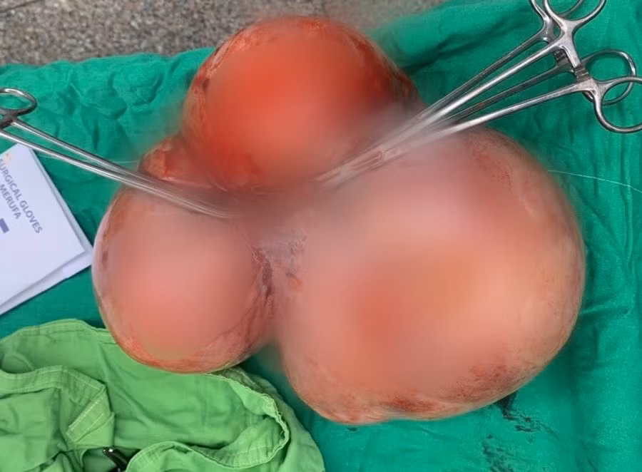 Khối u xơ tử cung nặng 5,5 kg được các bác sĩ bóc tách ra khỏi cơ thể bệnh nhân. Ảnh: Đình Tuyển