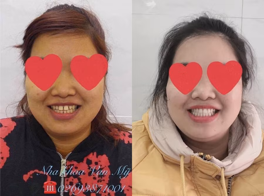 Nhiều người tự tin hơn với nụ cười của mình sau chỉnh nha tại Nha khoa Vạn Mỹ. 